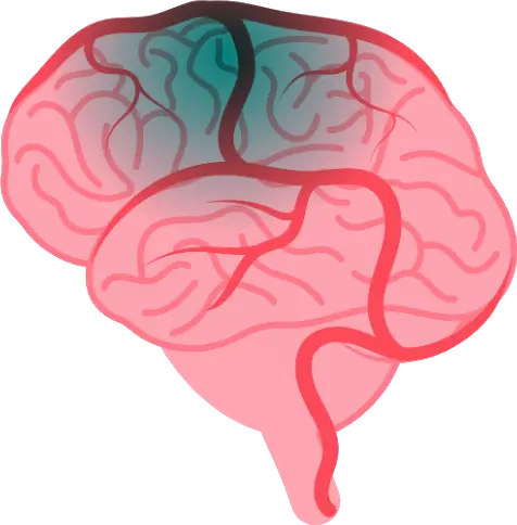 Illustration of brain with highlighted stroke area